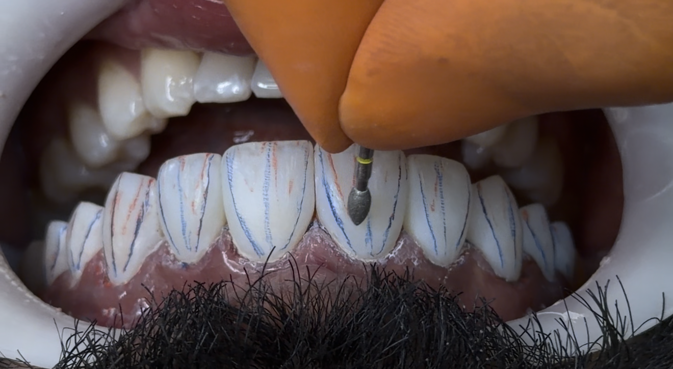 Acabamento ideal com protocolo