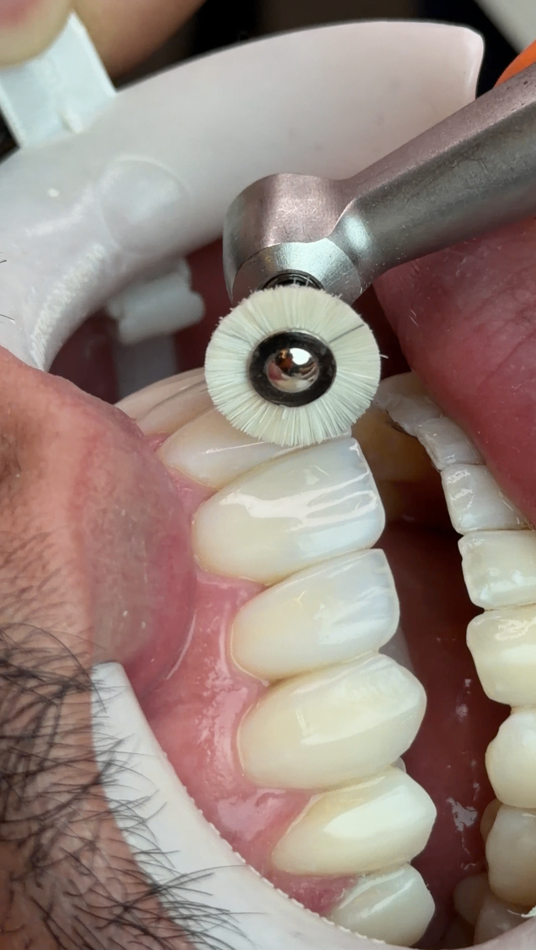 Escovação de brilho natural