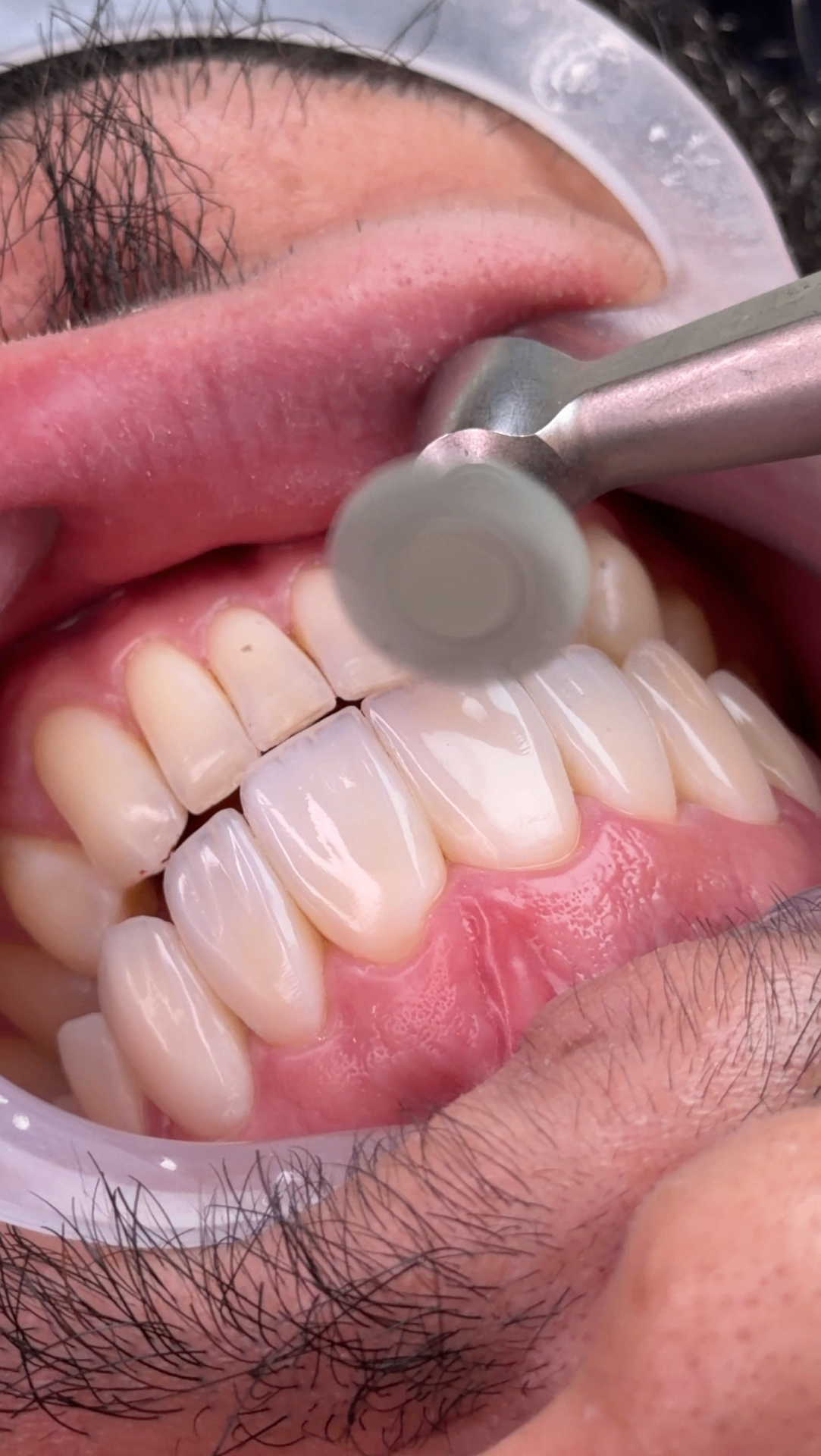 Polimento final em resina composta